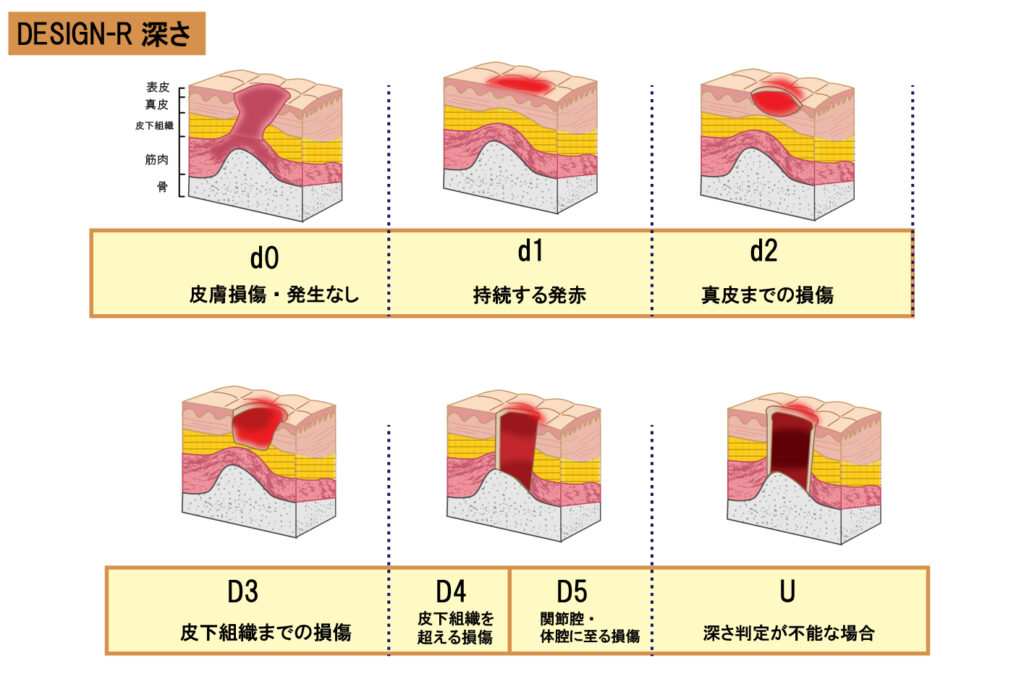 褥瘡とは何ですか?